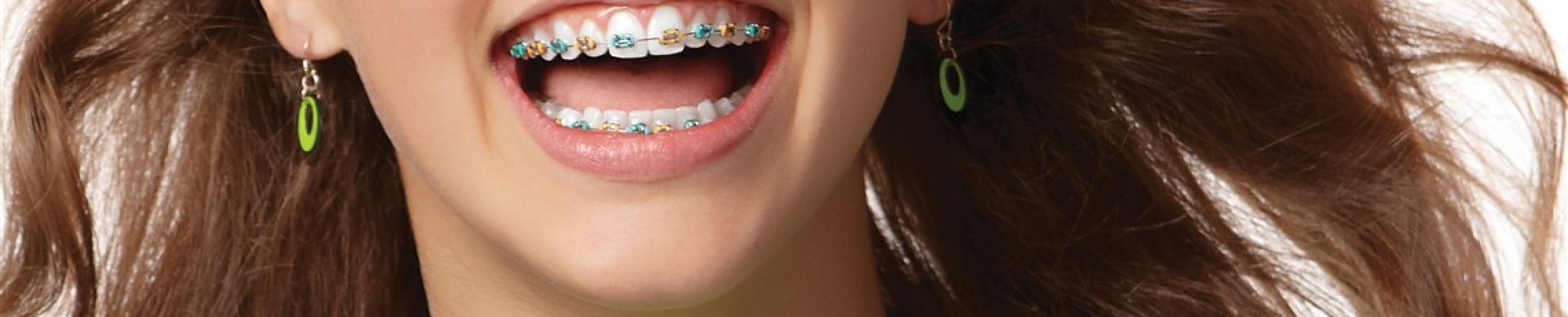 Metal Braces – the new bling?