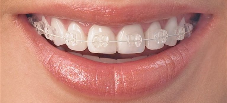 Top and bottom deals braces